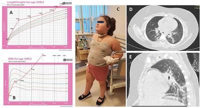 Case Report: COVID-19-Associated ROHHAD-Like Syndrome